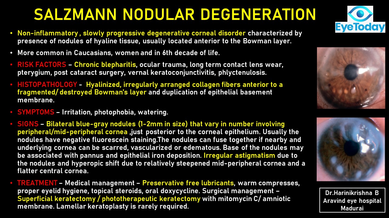 Salzmanns Nodular Degeneration E Oftalmo