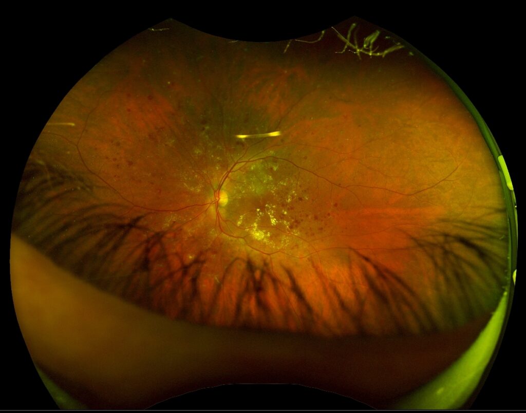 Ultra Wide Field Non Mydriatic Retinal Imaging System Eyetoday