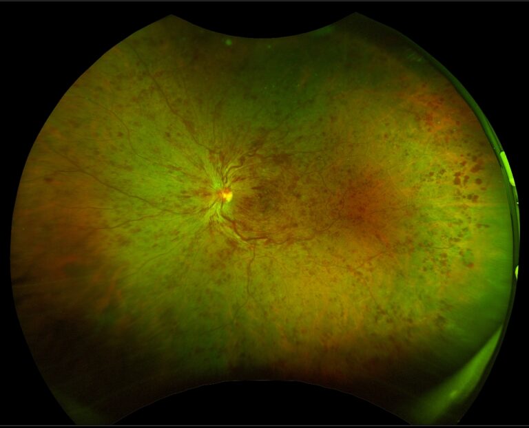 Ultra-Wide Field Non Mydriatic Retinal Imaging System - EyeToday