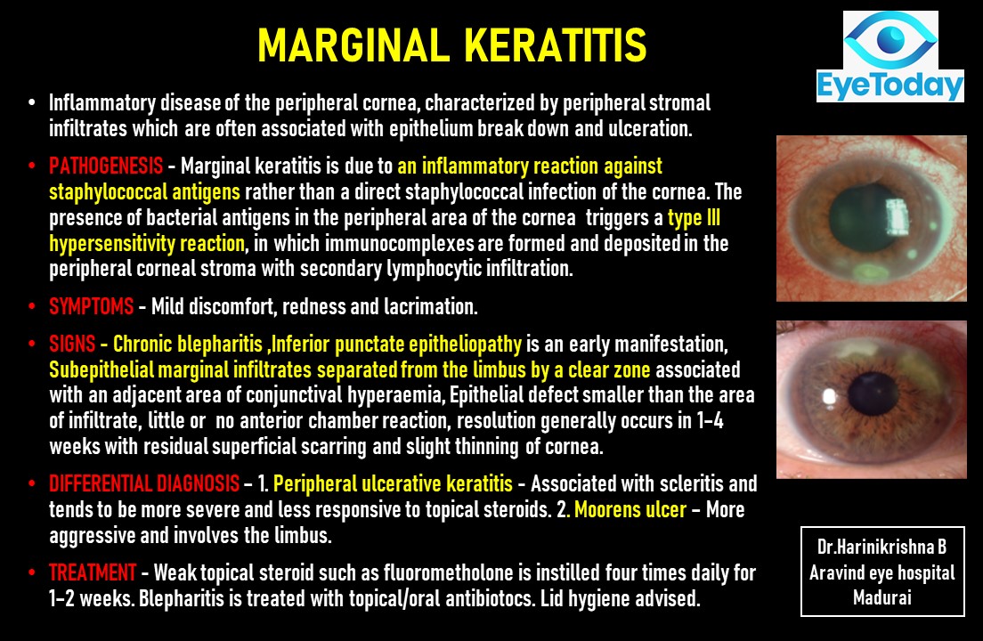 marginal keratitis