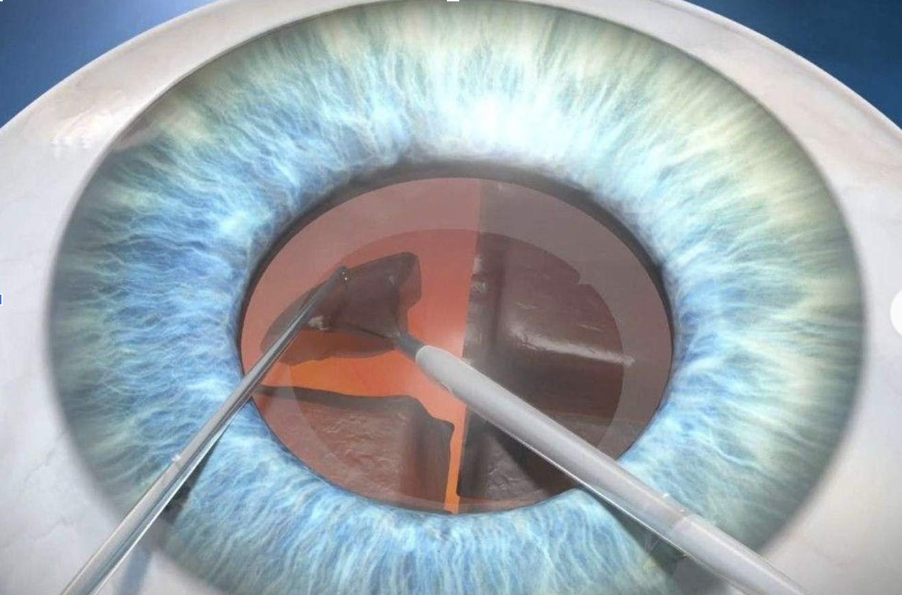 Замена хрусталика глаза как проходит операция. Спицевидная катаракта. Катаракта факоэмульсификация. Операция ультразвуковая факоэмульсификация катаракты. Этапы операции факоэмульсификации катаракты.