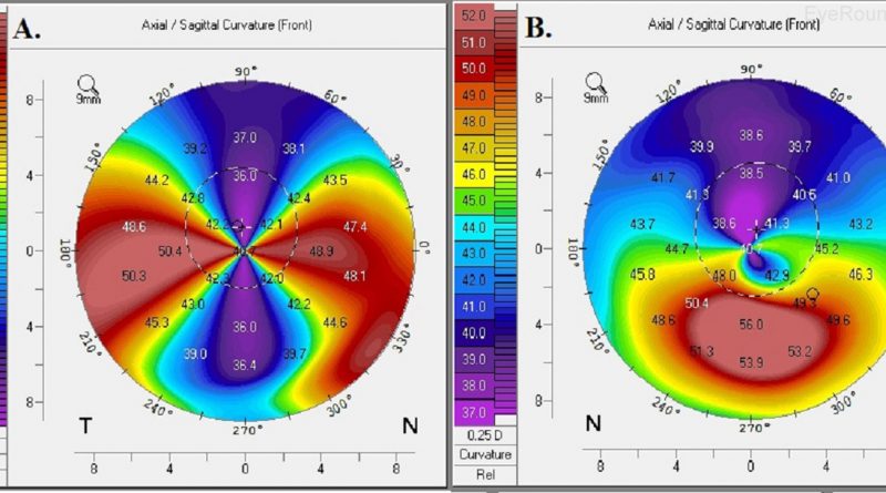 Posterior Corneal Astigmatism In Toric IOL Power Calculation - EyeToday