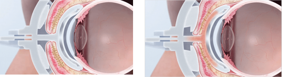 LipiFlow® Thermal Pulsation System: A New Dry Eye Treatment for MGD