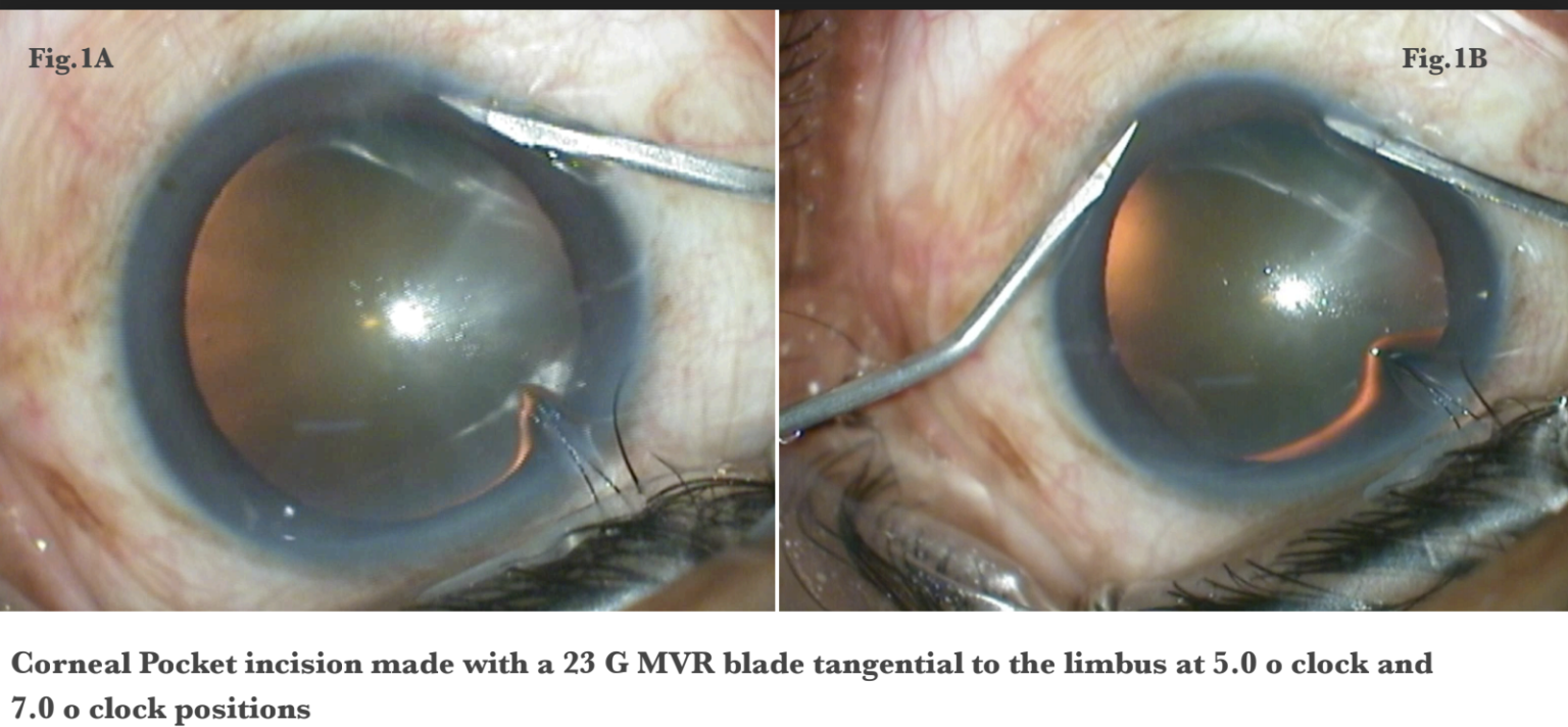 The Corneal Pocket fixation incision A novel way to achieve painless