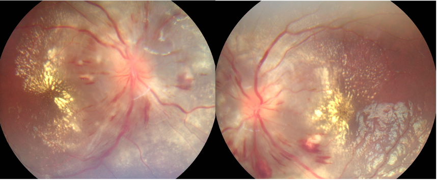 hypertensive retinopathy macular star