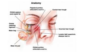 Tearful Tear Trough Anatomy Grading And Management EyeToday