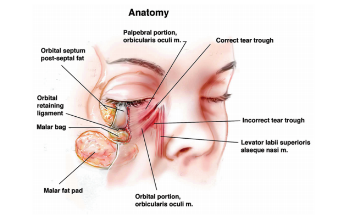Tearful Tear Trough: Anatomy, Grading and Management. - EyeToday